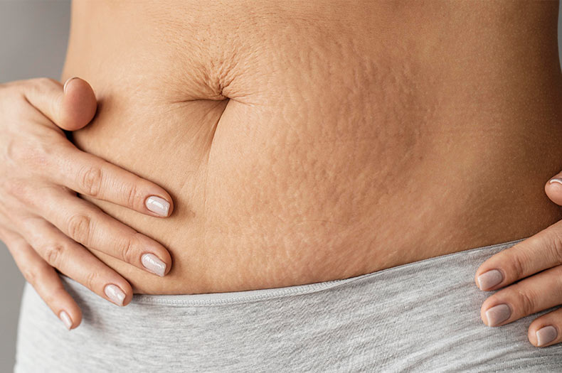 Stretch Marks Treatment | Skin Care Professionals